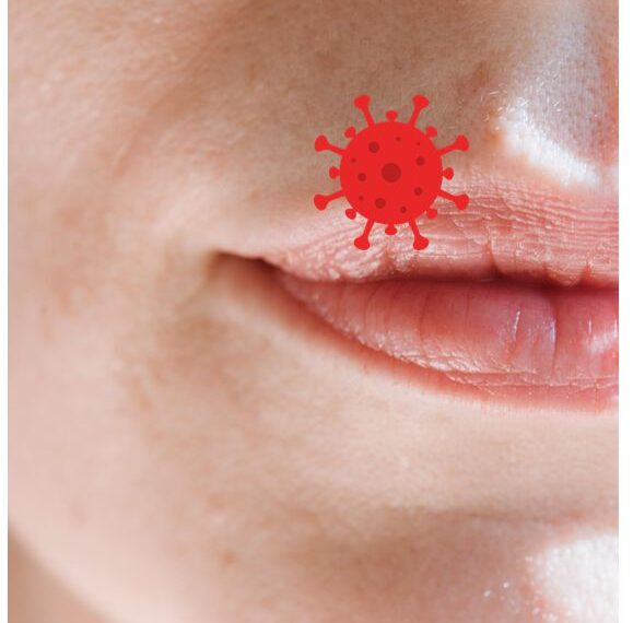 입술 수포(구순포진, 입술 헤르페스, 입술 물집) 관련 정보