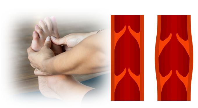 정맥질환과 하지정맥류 