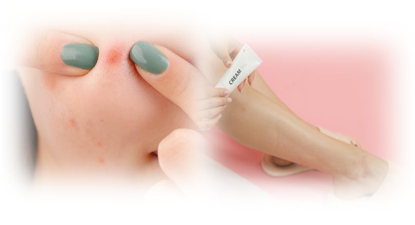 스테로이드와 여드름 