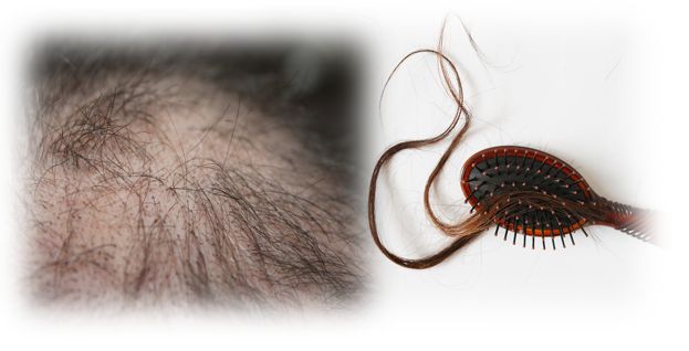 남성탈모 여성탈모