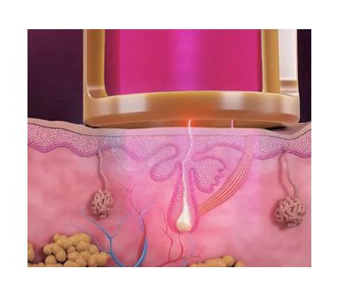 젠틀맥스프로플러스 작용기전 사진 