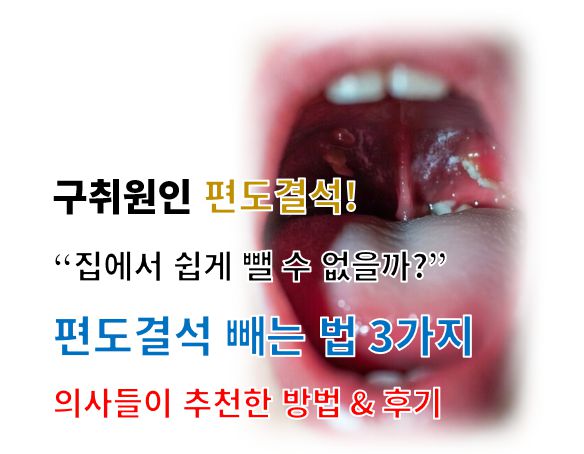 편도결석 빼는 법 정보 글 사진
