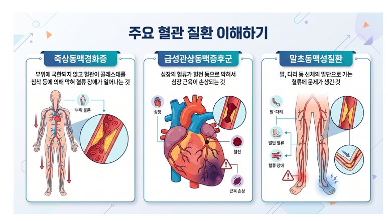 죽상동맥경화증 관상동맥증후군 말초동맥질환 등 주요 혈관 질환 용어 정리 